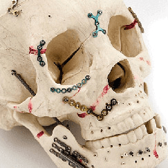 Cranio-maxillofacial implants